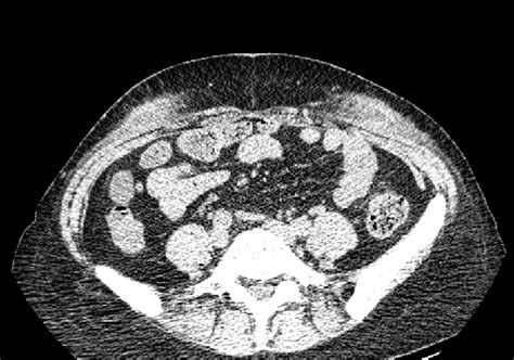 Ct Manifestations Of Abdominal Wall Lupus Panniculitis Download