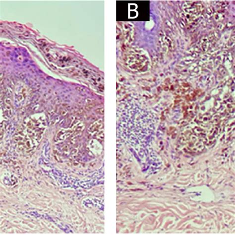 Bullous Lesion Borders Containing Tumor Cells And Loss Of Intercellular