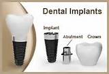 Images of How Much Does Insurance Cover For Dental Implants
