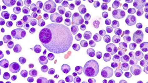 Myeloma Cells Oncotracker