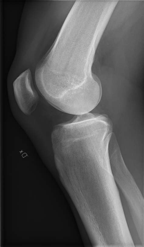 Filex Ray Of A Normal Knee By Anteroposterior Wikipedia 45 Off