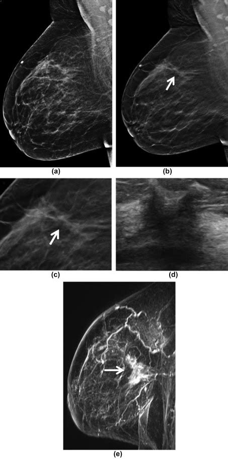 Assessment Of Disease Extent On Contrast Enhanced Mri In Breast Cancer