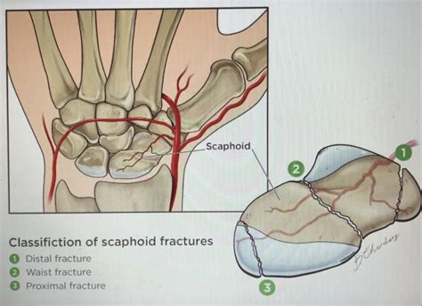 Scaphoid Fracture Andrews Sports Medicine