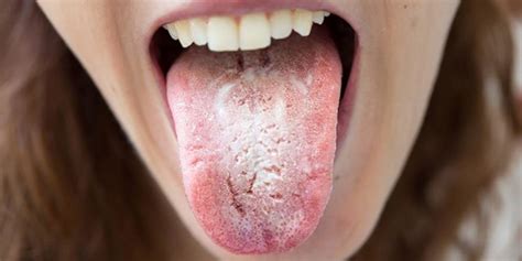 Mulut Kering Punca Dan Cara Rawatan The Diagnosa