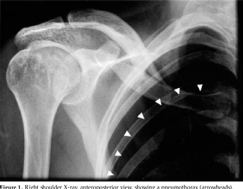 Figure 1 From Isolated Clavicle Fracture With Secondary Pneumothorax A