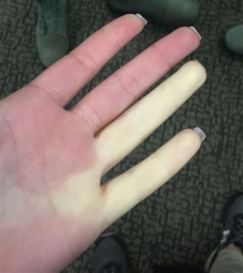 raynaud s phenomenon can turn fingers white villages