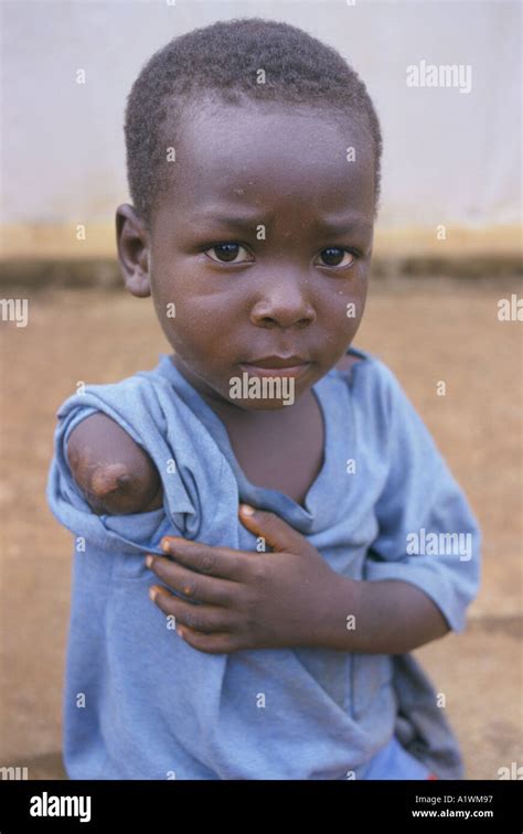 Amputees Sierra Leone Child With One Arm Maliciously Amputated By