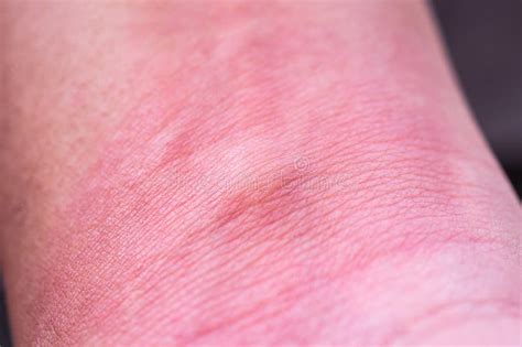Skin Allergy With Rash After Mosquito Bite Stock Image Image Of Itch