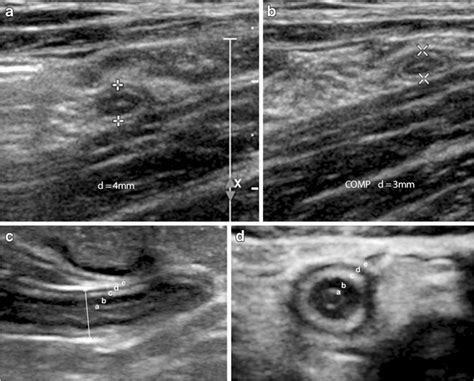 Normal Appendix A B Transverse Gray Scale Us Images With A And