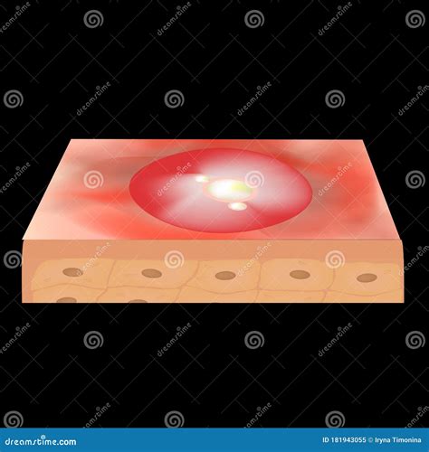 Cyst Acne Furuncle Acne On The Skin Cysts And Pimples Stock Vector