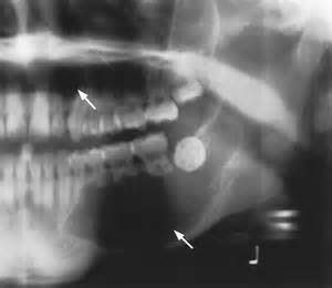 A Cyst In The Jaw Bone Video