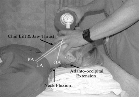 Mastering Bls Ventilation Core Techniques Ems Basics