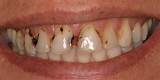 Images of Gum Line Cavity Treatment