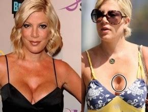 Tori Spelling Before And After Plastic Surgery Celebrity Plastic