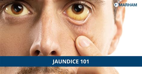Jaundice Treatment Causes Symptoms And Risks
