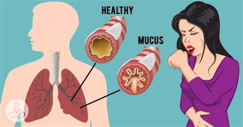 How To Get Rid Of Mucus And Phlegm In Your Chest And Throat As Fast As Possible Getting Rid Of