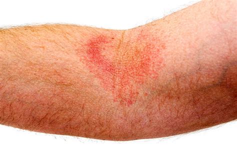 Red Rash Arm Stock Photos Pictures And Royalty Free Images Istock