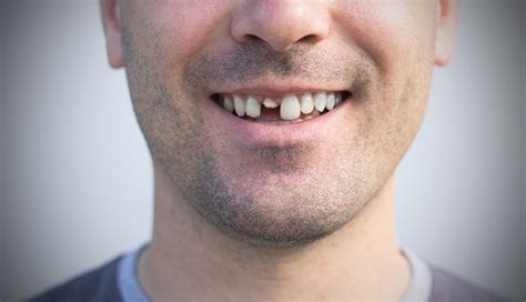 9 Most Common Causes Of Chipped Or Cracked Teeth Man Fat Tan