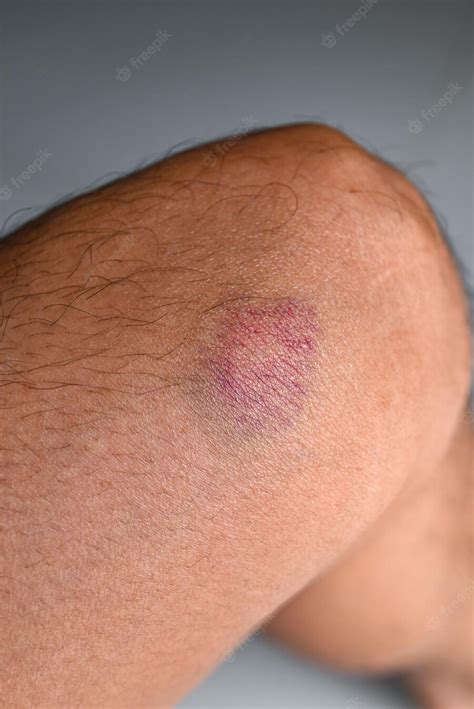 Premium Photo Bruised On Knee Wound Bruised On Leg Caused By Sports