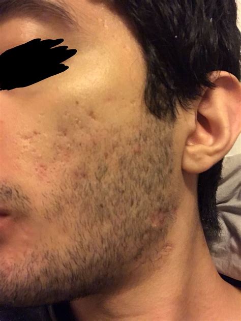 How Severe Is My Acne Scars What To Do About It Scar Treatments