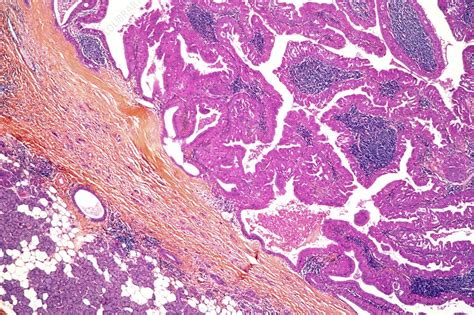 Parotid Gland Tumour Light Micrograph Stock Image C0072048