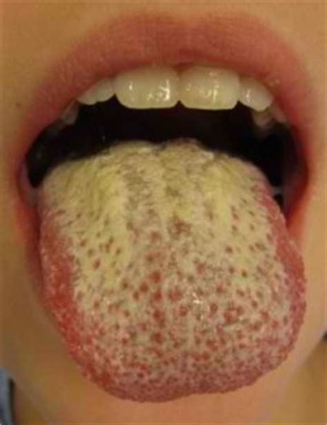 Lip fungal infections are highly treatable. Symptoms and Treatment for Yeast Infection in Mouth ...