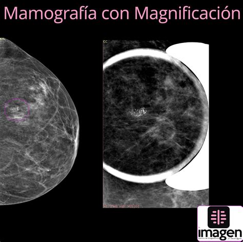 Mamografía Con Magnificación Centro De Diagnótico Imagen