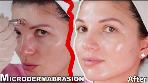 Microdermabrasion At Home 2021 Skin Expert Full Procedure And Before And After Results Youtube