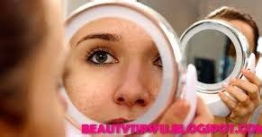 Motiya ka ilaj bagar operation k urdu hindi main,t. Home Remedies For Garmi Danay On Face Garmi Dano Se Nijat ...