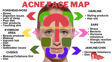 26 Breakouts On Face Map Online Map Around The World Vrogue Co