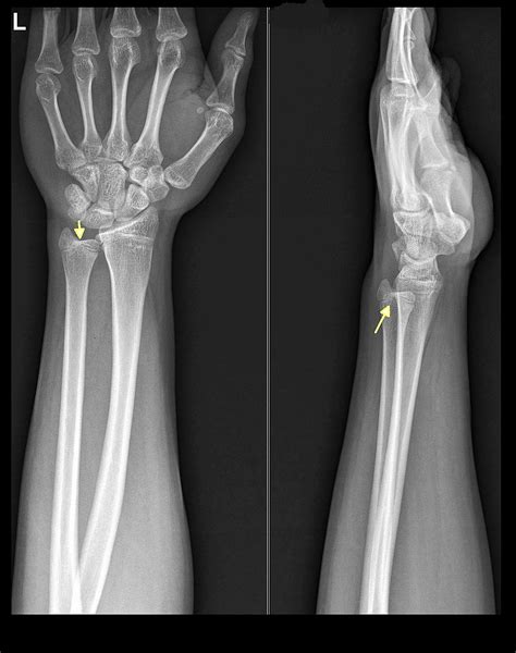 Cureus A Rare Case Of Isolated Type Iii Salter Harris Physeal Injury