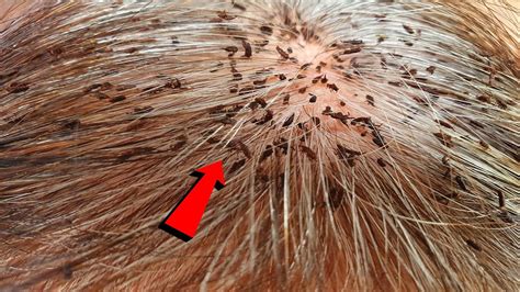 Remove Thousand Giant Lice From Mum Head Lice Combing Youtube