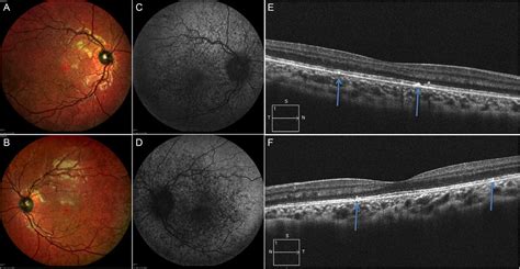 Pigmentary Retinopathy In Kearns Sayre Syndrome Bmj Case Reports
