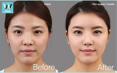 Short Nose Correction Plastic Surgery In Korea