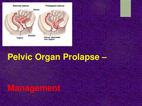 Pelvic Organ Prolapse Diagram