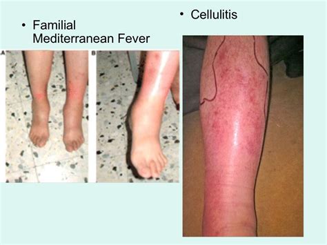 Mimics Of Infectiousdiseases