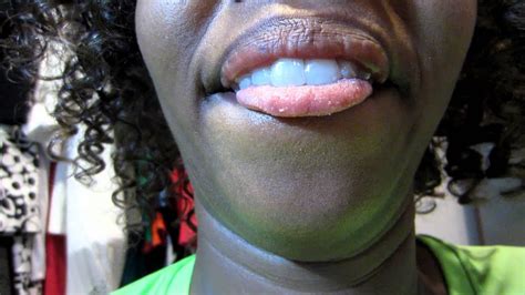 I Have A Zit On My Tongue I M A Freak Glozell Youtube