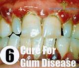 Photos of Gum Doctor Natural Remedy