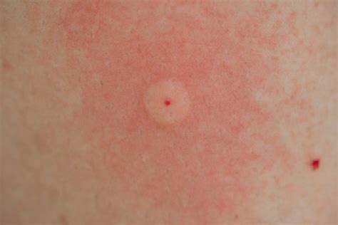 Common Summer Bug Bites And When To Seek Dermatology Care In Tn