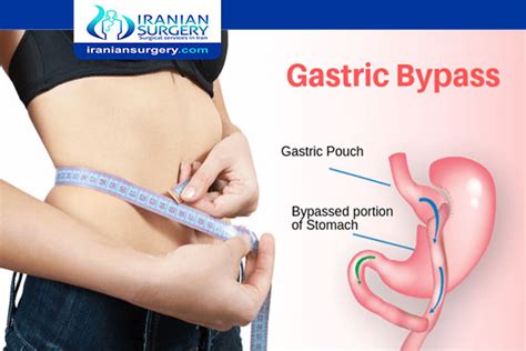 Mini Gastric Bypass Surgery Pros And Cons Disadvantages Iranian Surgery