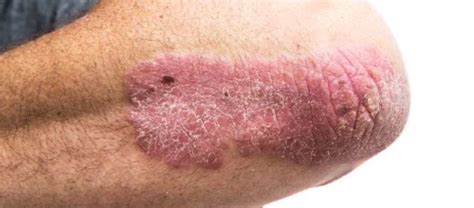 Ilumya Approved For Moderate To Severe Plaque Psoriasis Mpr