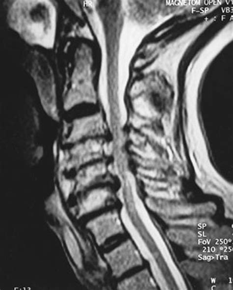 Spinal Cord Compression Causes Symptoms Diagnosis And Treatment