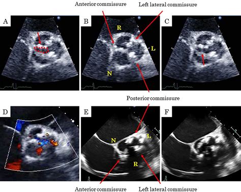 Figure 3 From An Adult Case Of Unicommissural Unicuspid Aortic Valve