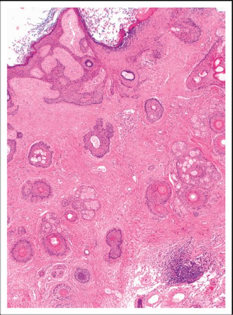 Left Ovarian Cyst Histopathology Aspect In He Coloration Sugestive For