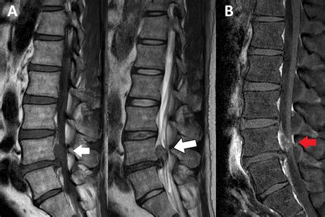 Cureus A Severe Disc Herniation Mimics Spinal Tumor