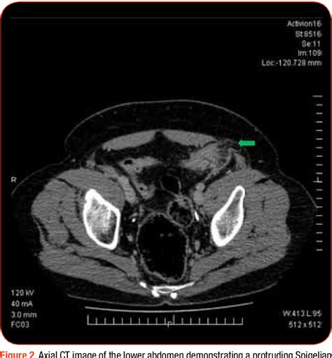 Figure 1 From The Role Of Computer Tomography In The Diagnosis Of