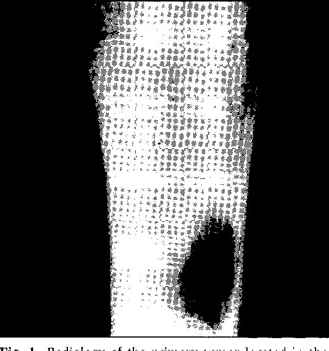 Figure 1 From Primary Rhabdomyosarcoma Mimicking A Small Cell Sarcoma