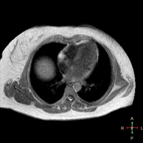 Horseshoe Kidney With Hypoplastic Left Lobe Radiology Case