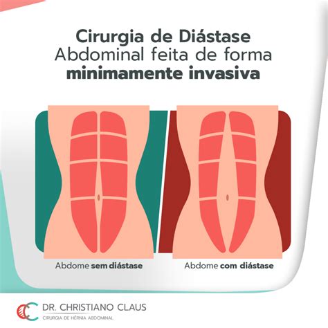 Cirurgia De Diástase Abdominal Feita De Forma Minimamente Invasiva Dr