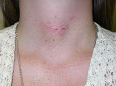 Scar After Thyroid Surgery Minimally Invasive Thyroid Surgery